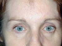 eyebrow lift surgery results photo